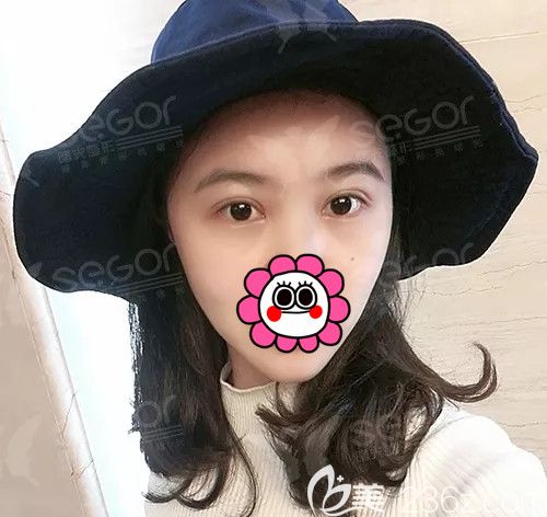 术后一周PARK法双眼皮恢复情况 术后一周PARK法双眼皮恢复情况