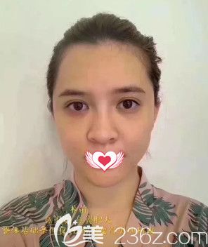 在邢台美加美做鼻综合前鼻子塌平 在邢台美加美做鼻综合前鼻子塌平