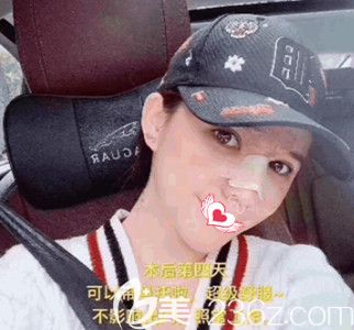 陈誉华院长为我做鼻综合4天后基本消肿 陈誉华院长为我做鼻综合4天后基本消肿