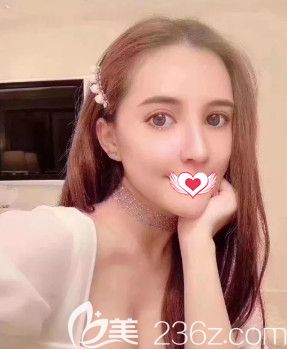 记录在邢台遇见美做鼻综合术后1个月的恢复情况 没想到我的矮塌鼻也能蜕变欧美范的高挺鼻