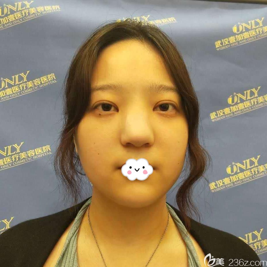 武汉壹加壹李艳东鼻综合真人案例 武汉壹加壹李艳东鼻综合真人案例