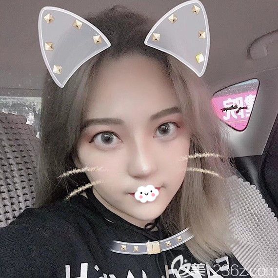 武汉壹加壹李艳东韩式生科假体隆鼻术后效果 武汉壹加壹李艳东韩式生科假体隆鼻术后效果