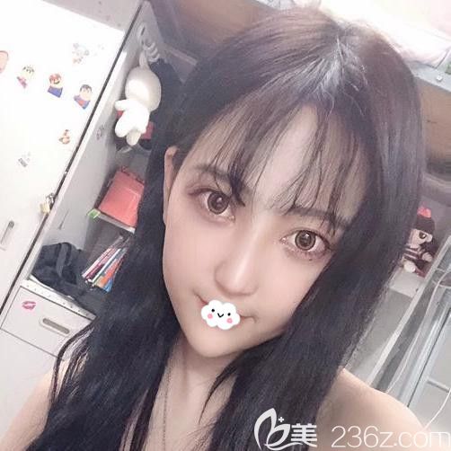 武汉壹加壹李艳东假体隆鼻案例术后恢复效果图 武汉壹加壹李艳东假体隆鼻案例术后恢复效果图