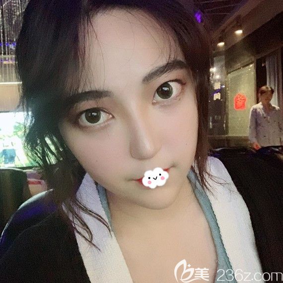 武汉隆鼻哪家医院好?武汉壹加壹李艳东鼻综合案例 武汉隆鼻哪家医院好?武汉壹加壹李艳东鼻综合案例