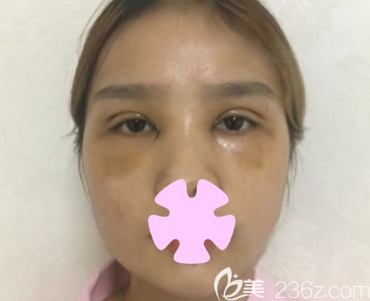 我在桂林华美整形做双眼皮加激光祛斑第6天