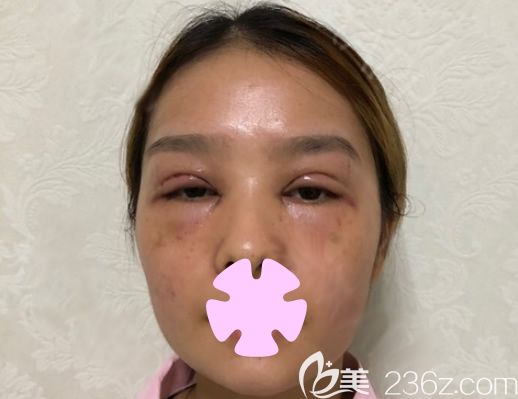 我在桂林华美做无痕双眼皮和祛斑术后第2天