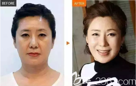 贵阳华美整形线雕效果怎么样? 贵阳华美整形线雕效果怎么样?