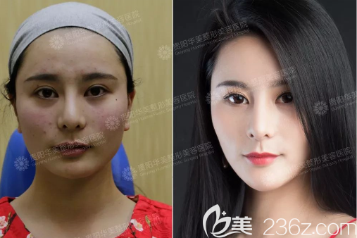 贵阳华美玻尿酸填充太阳穴案例 贵阳华美玻尿酸填充太阳穴案例