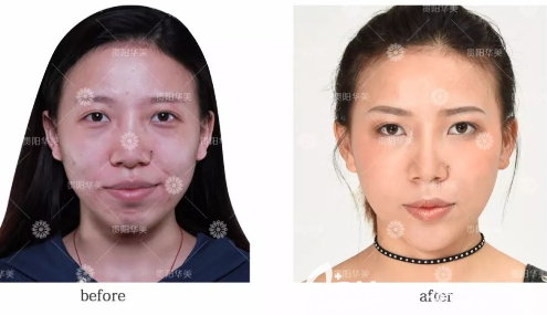 贵阳华美玻尿酸丰苹果肌效果怎么样 贵阳华美玻尿酸丰苹果肌效果怎么样