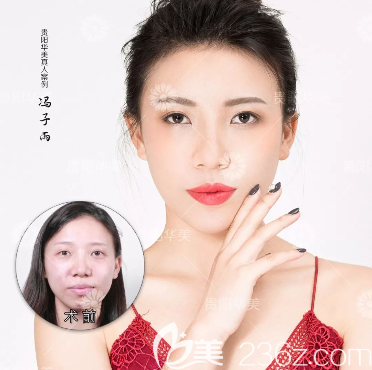 玻尿酸填充术后效果 玻尿酸填充术后效果