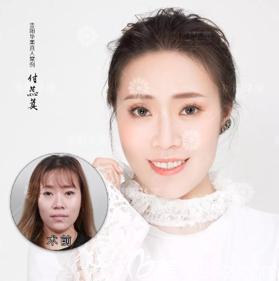 贵阳华美玻尿酸注射前后对比 贵阳华美玻尿酸注射前后对比