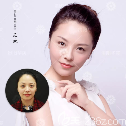 玻尿酸丰下巴案例 玻尿酸丰下巴案例