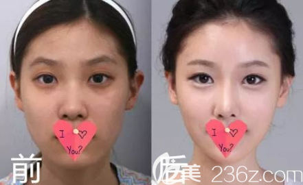 贵阳美贝尔玻尿酸隆鼻案例 贵阳美贝尔玻尿酸隆鼻案例