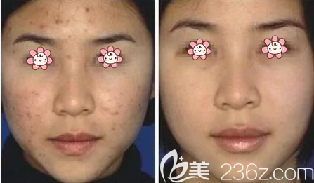 果酸祛痘案例 果酸祛痘案例