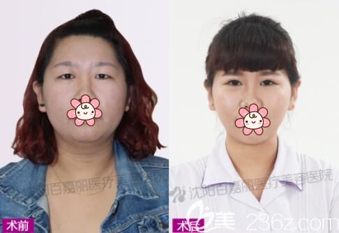 侯亚杰切开双眼皮真人恢复效果