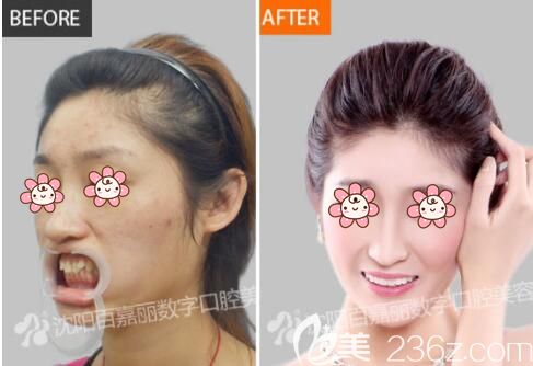 刘文波医生做牙齿矫正与皮肤改善术后恢复对比