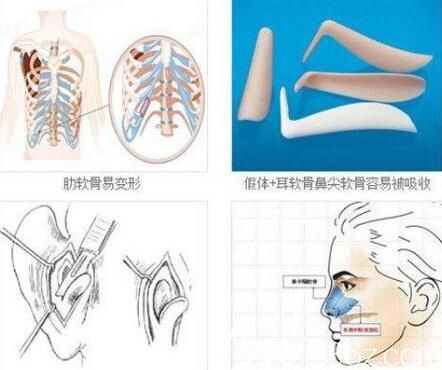 假体和自体软骨隆鼻图解
