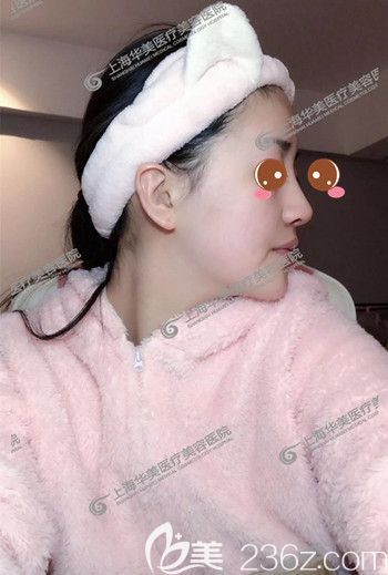 上海华美医疗美容医院李健鼻综合+自体脂肪面部填充真人案例术后第七天