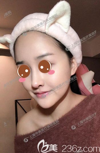 上海华美医疗美容医院李健鼻综合+自体脂肪面部填充真人案例术后二十一天