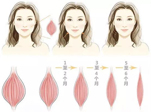 瘦脸除皱瘦脸效果 瘦脸除皱瘦脸效果