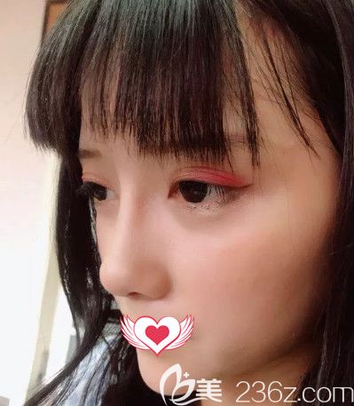 张丙海医生做自体软骨隆鼻术后25天完全消肿