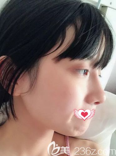 邯郸京美张丙海做完自体软骨隆鼻术后10天消肿