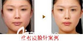 邯郸维多利亚2月14日情人节专场优惠来袭 580元的双眼皮让你超值变美