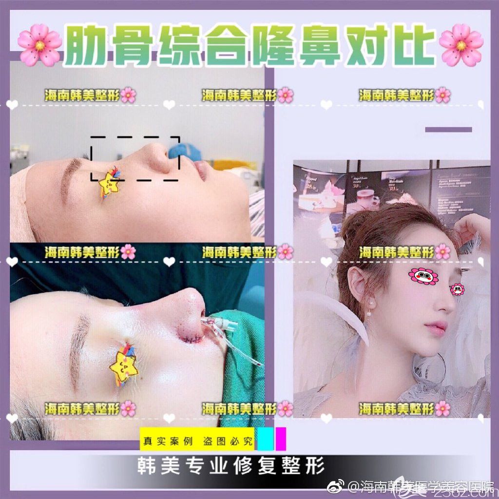 海南韩美整形隆鼻真人案例效果图 海南韩美整形隆鼻真人案例效果图