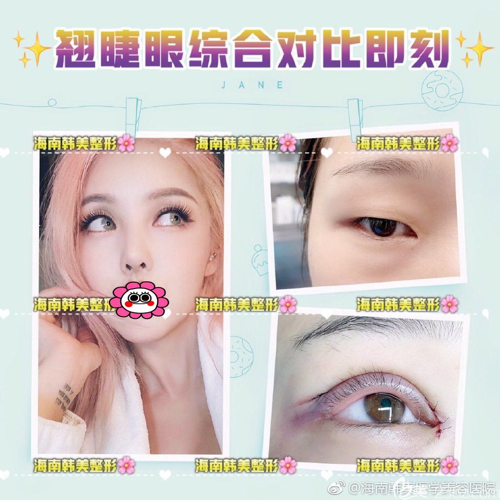 情人节海南韩美特惠整形价格来袭，双眼皮低至1280元附陈柳艺/梁如光真人案例