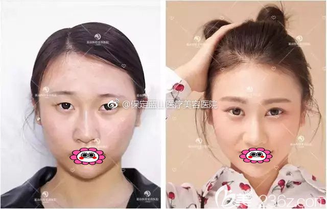 保定蓝山卢闯双眼皮效果图