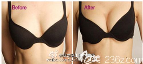 保定蓝山杜建龙自体脂肪丰胸对比图