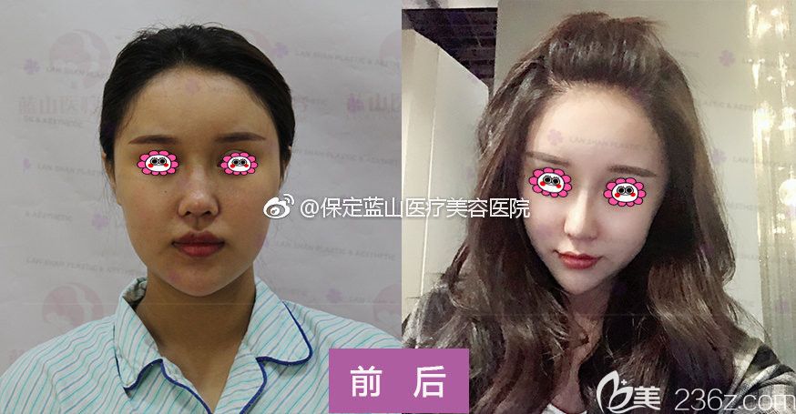 保定蓝山整形医院隆鼻真人案例变化图