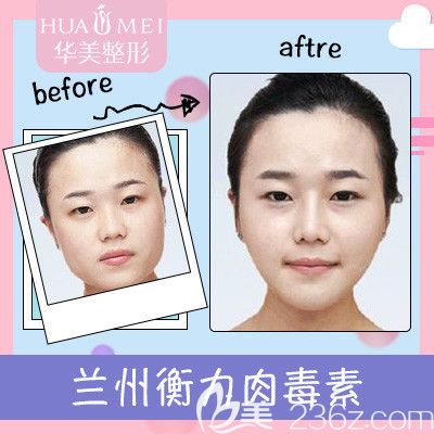 汕头华美瘦脸680元附案例