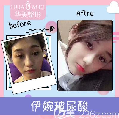 汕头华美玻尿酸注射案例