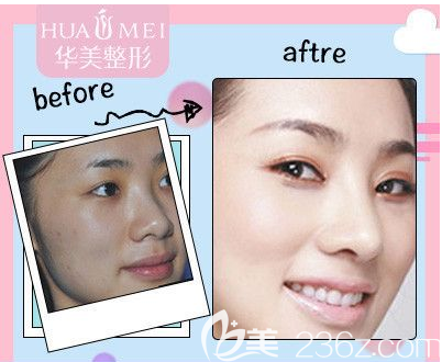 汕头华美注射案例效果图