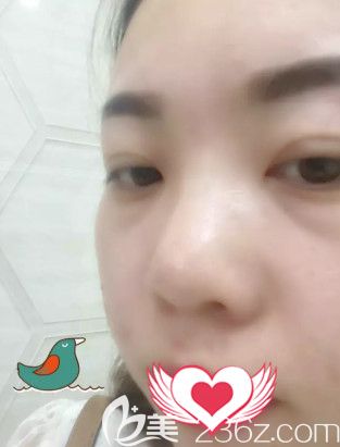 在<!--<i data=20240703-sp></i>-->整形美容医院刷果酸第15天摆脱肌肤暗沉 在<!--<i data=20240703-sp></i>-->整形美容医院刷果酸第15天摆脱肌肤暗沉