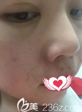 杨莎莎医生刚为我做完果酸换肤皮肤明显改善 杨莎莎医生刚为我做完果酸换肤皮肤明显改善