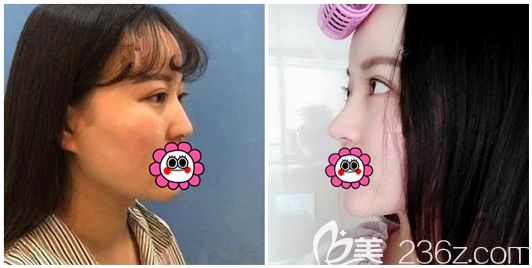 周国伟主任假体隆鼻术后效果对比 周国伟主任假体隆鼻术后效果对比