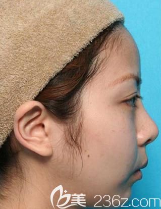 在日本美真美容做双眼皮修复手术前侧面拍照