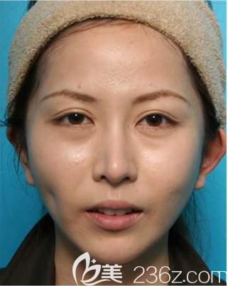 在日本美真美容做双眼皮修复，福田庆三给了我一双会说话的眼睛