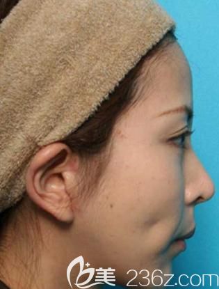 在日本美真美容找福田庆三做双眼皮修复手术后侧面 在日本美真美容找福田庆三做双眼皮修复手术后侧面