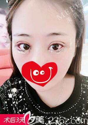 做完眼综合手术术后三天两边眼睛宽度不一