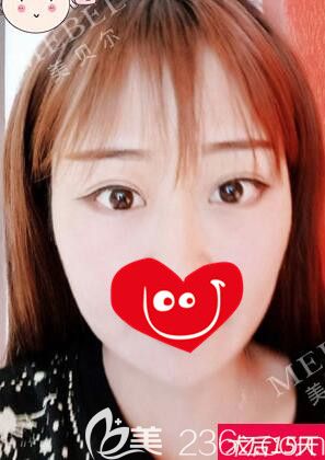 南京美贝尔分享眼综合术后半个月恢复