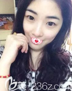 在保定蓝山做鼻综合术前鼻子塌平 在保定蓝山做鼻综合术前鼻子塌平