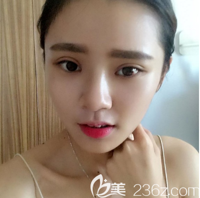 去汕头华美做完双眼皮10天自拍