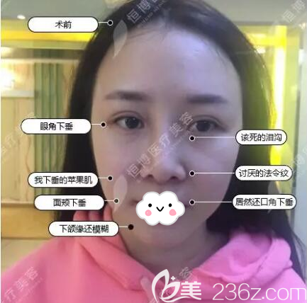 做线雕治疗前的素颜照片 做线雕治疗前的素颜照片