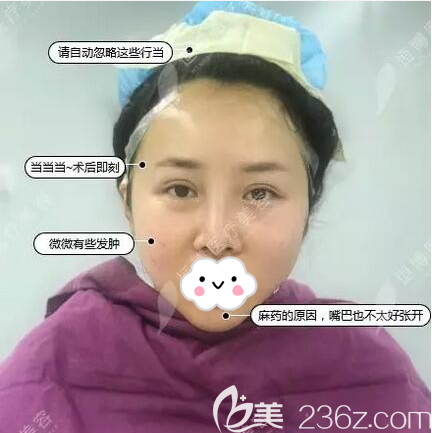 成都恒博线雕术后即刻效果 成都恒博线雕术后即刻效果