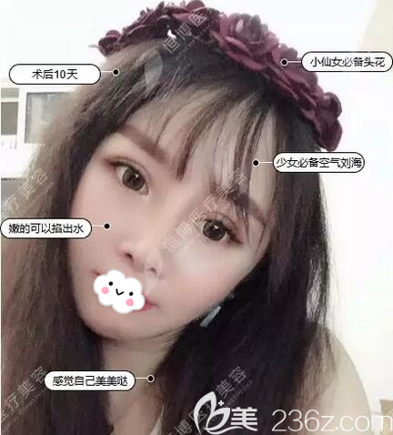 埋线提升术后10天恢复照 埋线提升术后10天恢复照