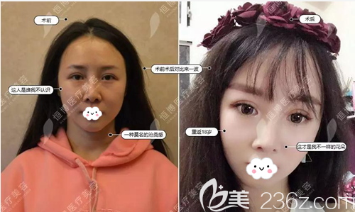 成都恒博牟燕萍线雕提升术前术后对比照片 成都恒博牟燕萍线雕提升术前术后对比照片