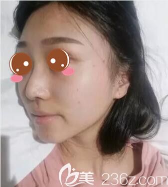 上海丽质医疗美容门诊部卢九宁鼻小柱+鼻中隔延长+耳软骨鼻尖真人案例术后一个月